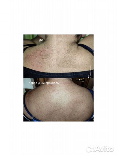 Электроэпиляция