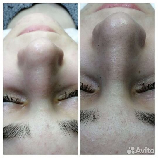 Чистка лица