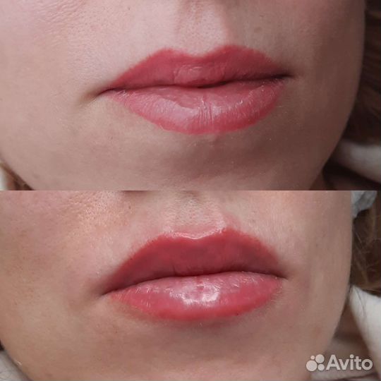 Биоревитализация