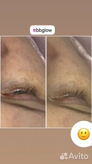 Фракционная мезотерапия/микронидлинг/bbglow