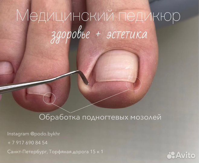 Медицинский педикюр Подолог