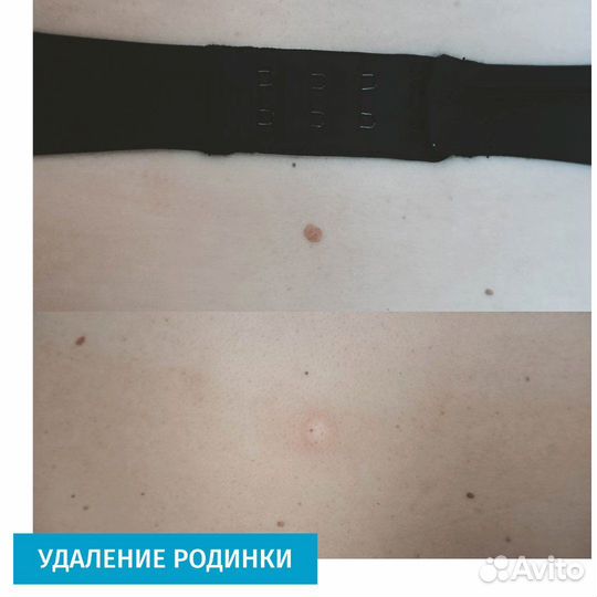 Удаление родинок лазером