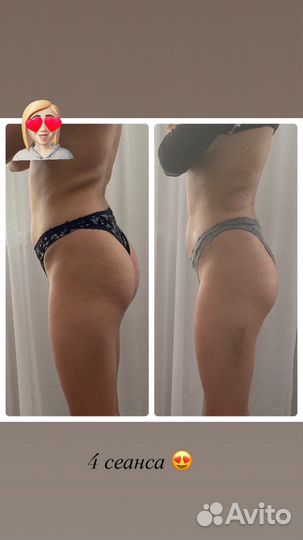 Вакуумный массаж, коррекция фигуры, массаж