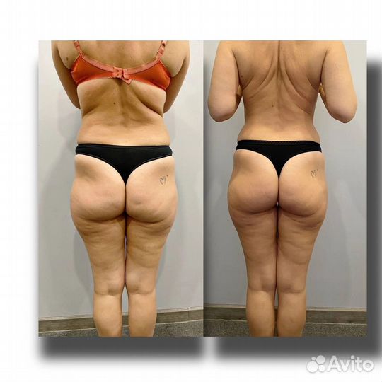 Экспресс коррекция фигуры LPG, кавитация, вакуум