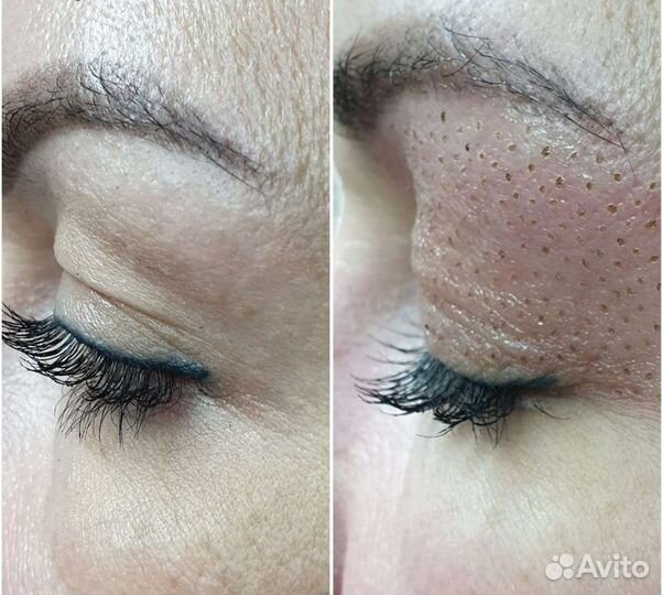 Блефаропластика горячей плазмой