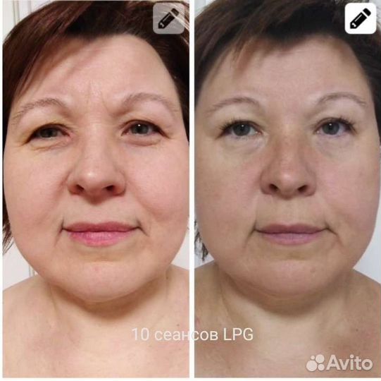 LPG тела и лица спб