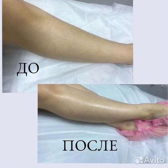 Шугаринг/Депиляция воском