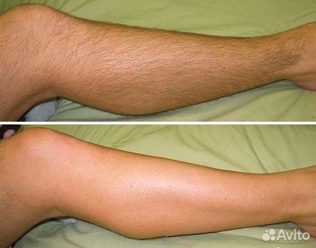 Лазерная эпиляция ищу модель