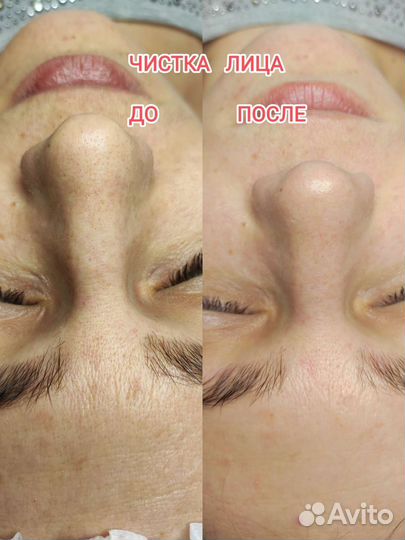 Биоревитализация