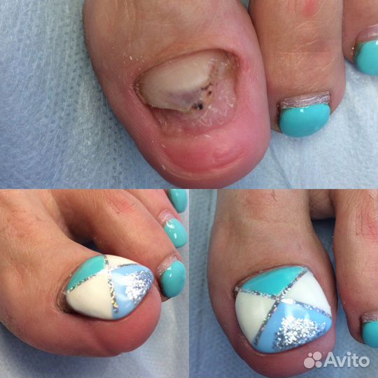 Медицинский аппаратный педикюр