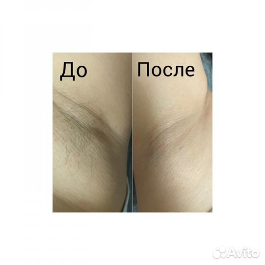 Депиляция воском