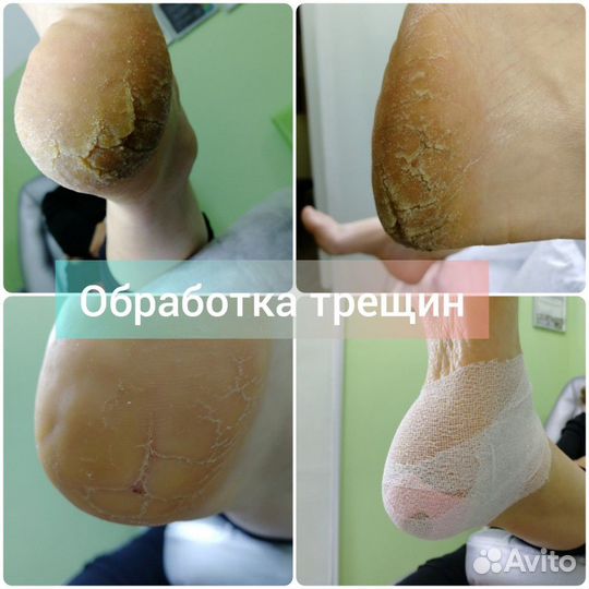 Лечебный педикюр