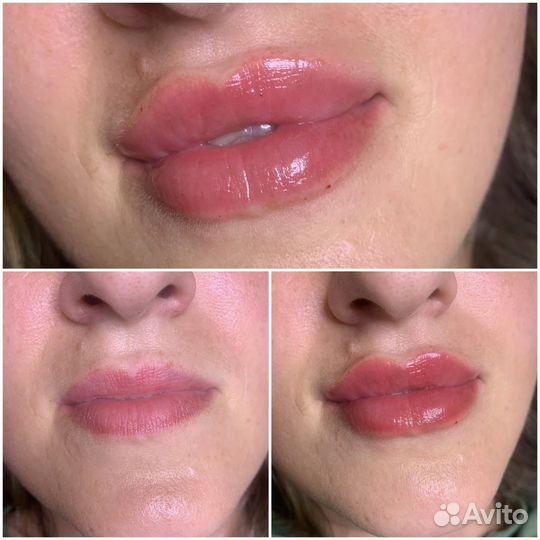 Увеличение губ / Лифтинг/ Ботокс
