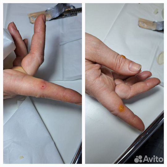 Педикюр проблемных стоп и ногтей (Подолог)