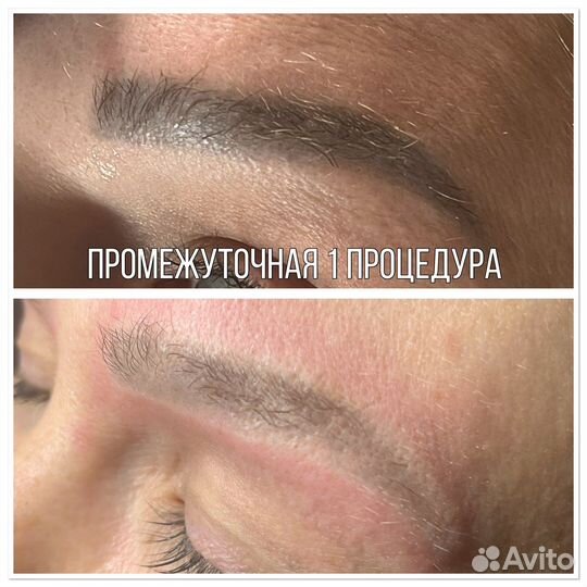 Удаление тату/ татуажа/карбоновый пилинг