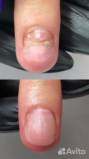 Протезирование ногтей