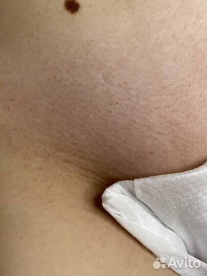 Депиляция воском: подмышки