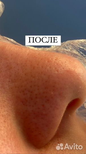 Чистка лица