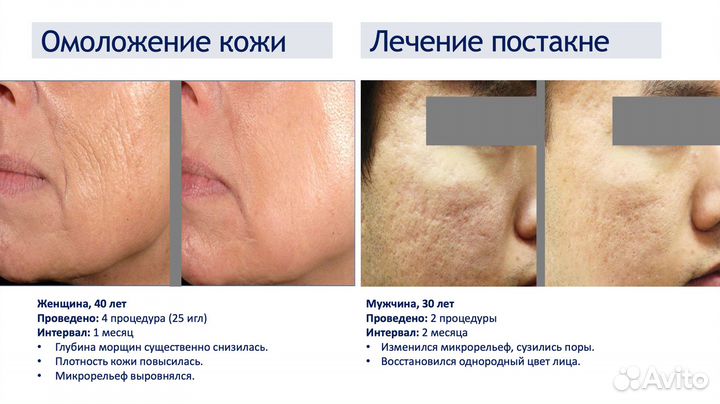 Микроигольчатый РФ лифтинг