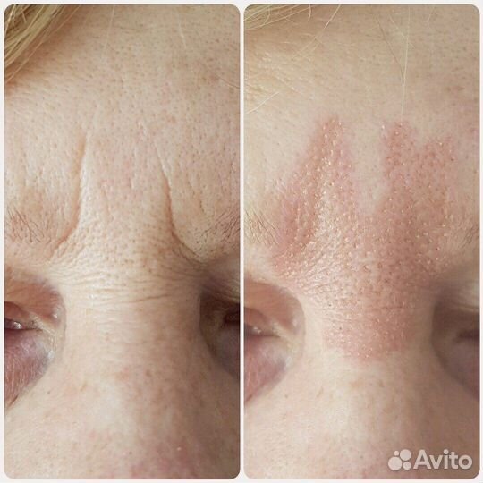 Холодная плазма/обучение