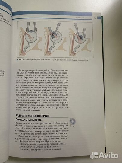 Хирургия косоглазия