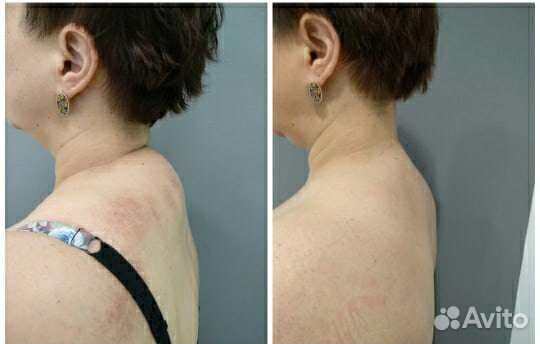 LPG массаж, B-flexy, R-sleek