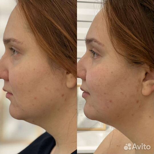 Массаж ручной Массаж lpg Косметолог