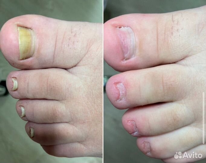 Лечебный педикюр подолог