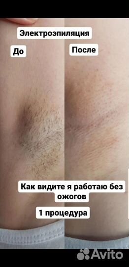 Электроэпиляция