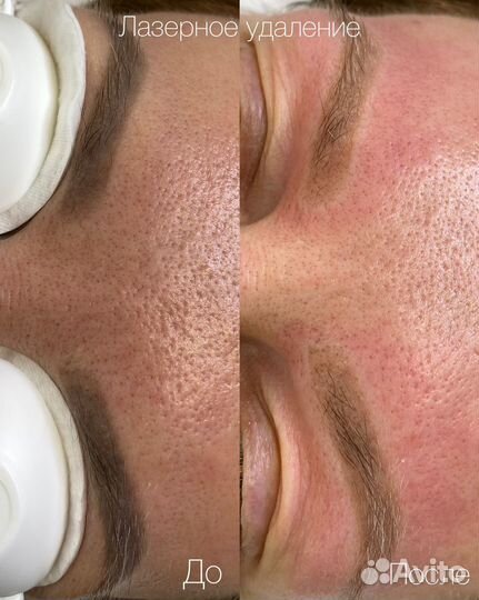 Удаление/осветление тату и татуажа лазером