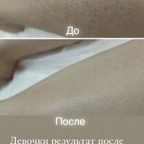 Лазерная эпиляция Видное, Видное