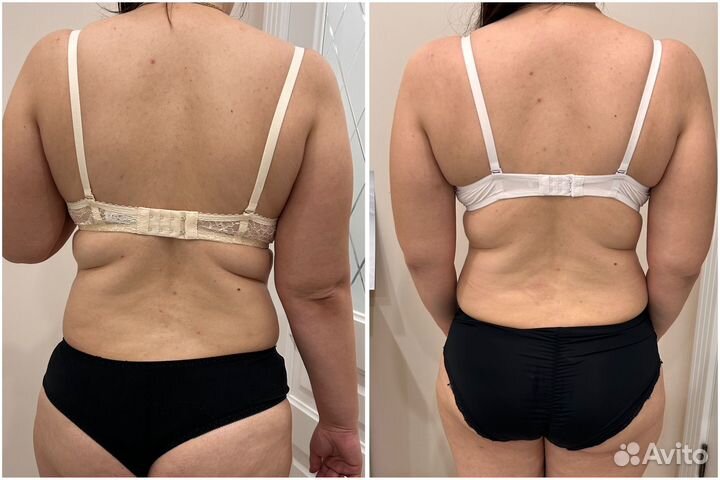 LPG массаж лица и тела