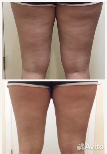 Антицеллюлитный Лимфодренажный массаж Обертывания