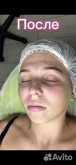 Косметолог чистка лица пилинги