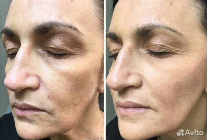 Безоперационная подтяжка лица / RF - лифтинг