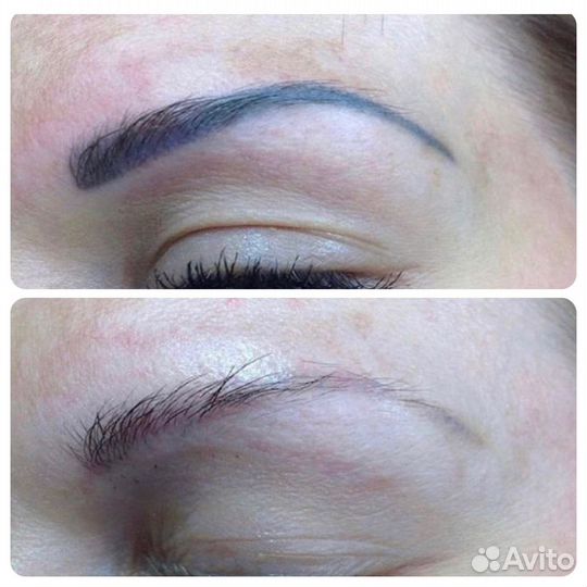 Лазерное удаление татуажа и татуировок