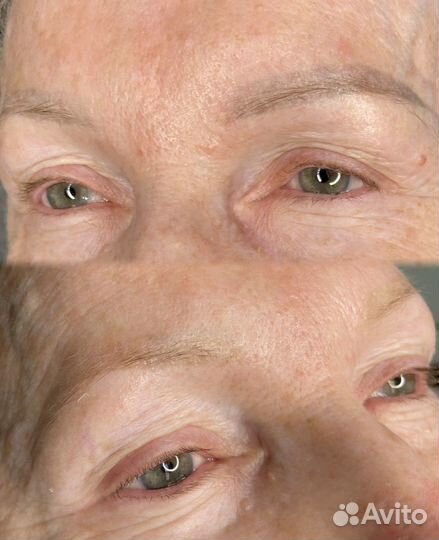 Удаление тату и татуажа