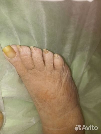 Медицинский педикюр на дому