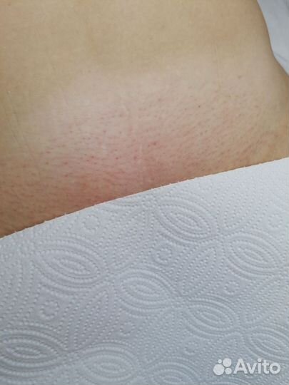 Эпиляция воском