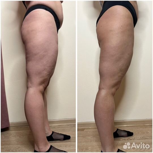 Модель на антицеллюлитный массаж