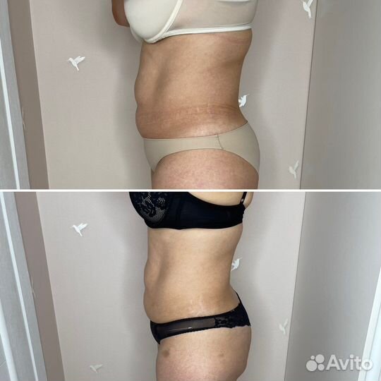 LPG массаж, микроигольчатый RF-лифтинг, кавитация