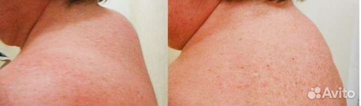 Массаж, тейпирование, rf лифтинг, кавитация