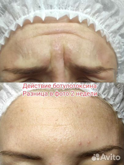 Биоревитализация