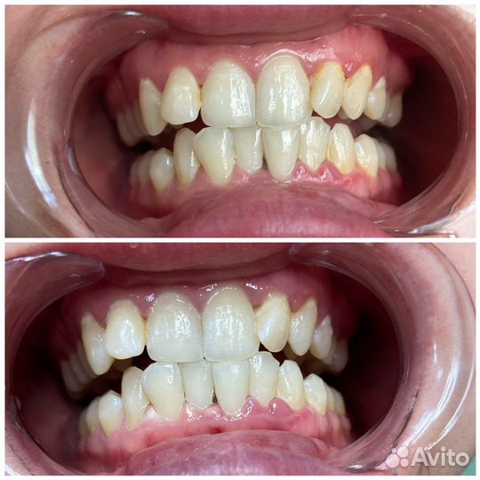 Косметическое отбеливание зубов