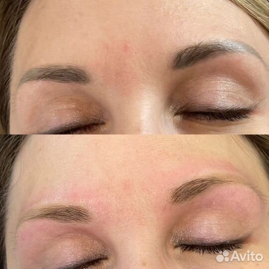 Удаление татуажа, татуировок,перманентного макияжа