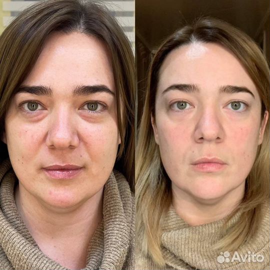 Плазмолифтинг