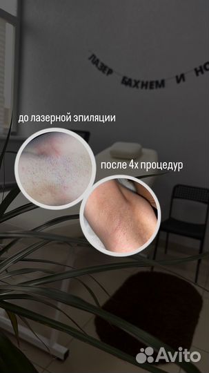 Лазерная эпиляция