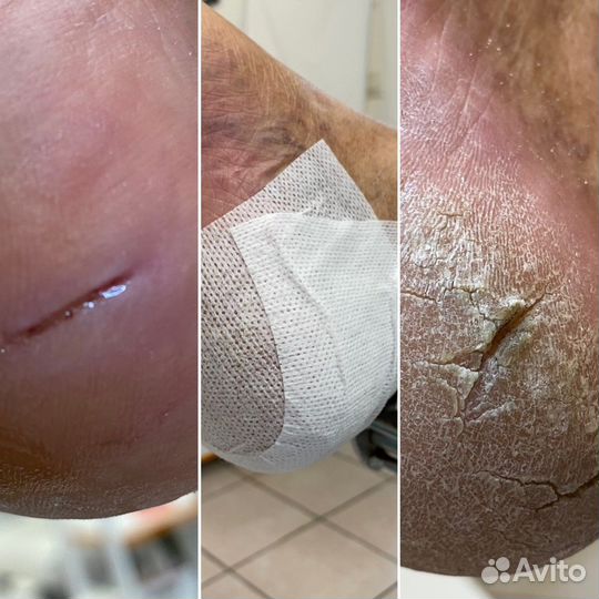 Подологический уход любой сложности