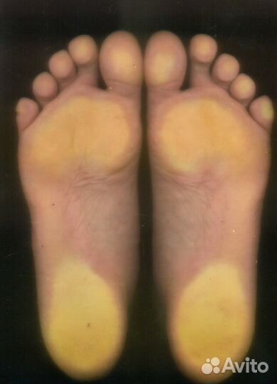 Индивидуальные ортопедические смарт-стельки