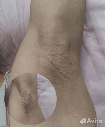 Шугаринг депиляция удаление волос воском